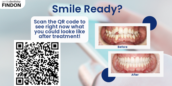 Smile Ready Invisalign Open Day1